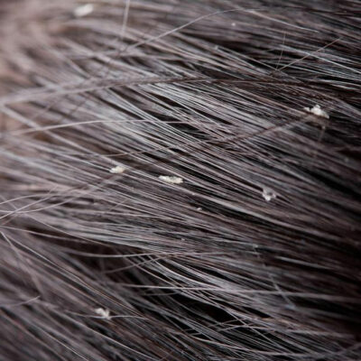 Causes and Prevention of Dandruff