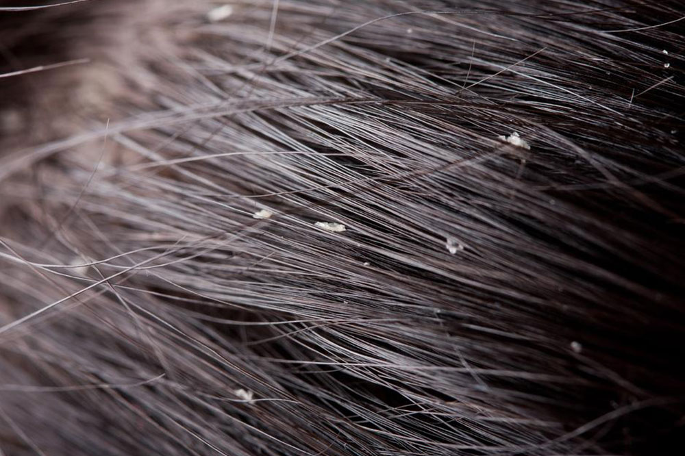 Causes and Prevention of Dandruff